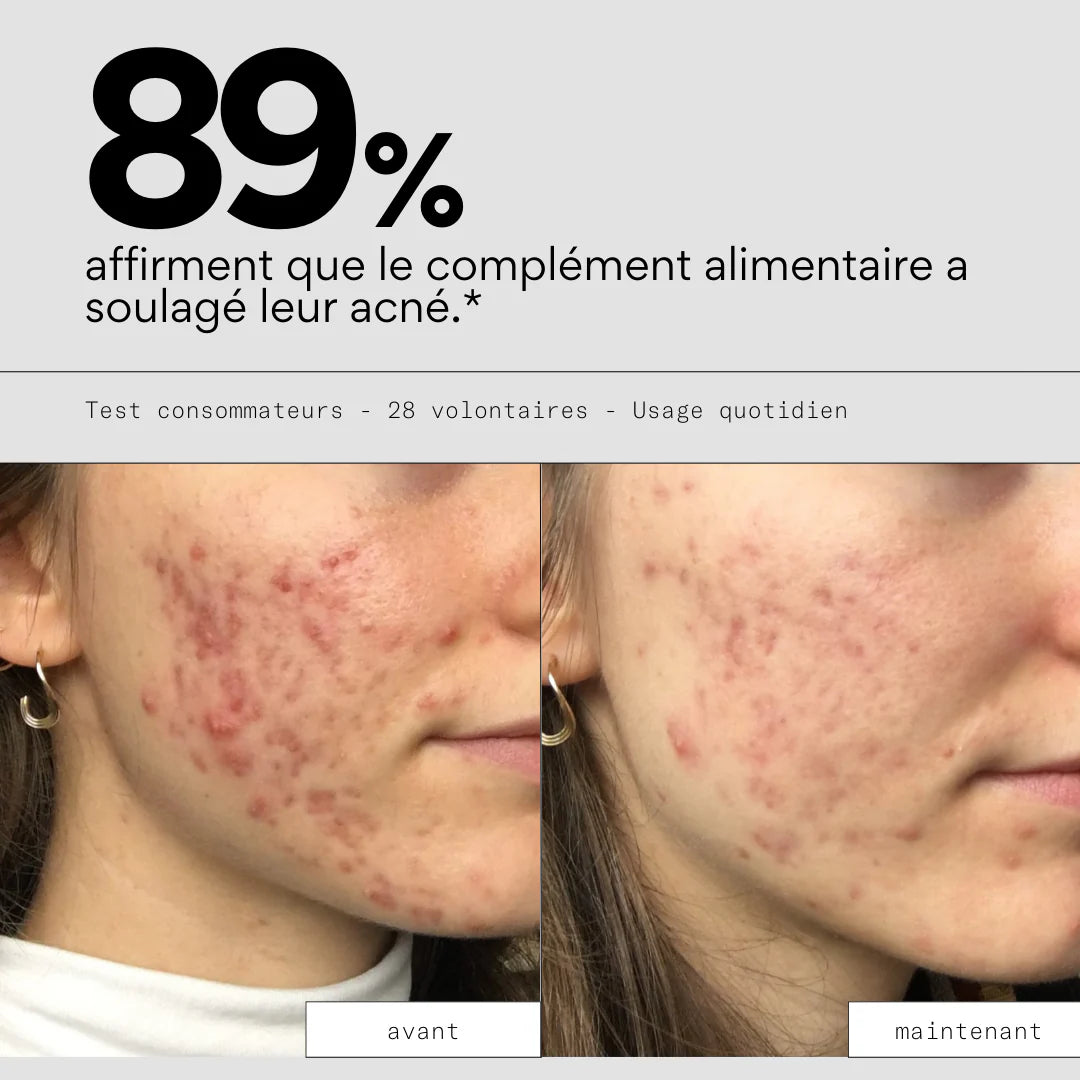 Complément alimentaire anti-boutons - SKIN & OUT